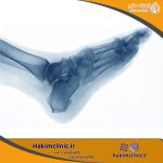 خارپاشنه چیست، علل، علائم و درمان