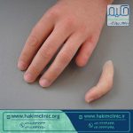 ساخت پروتز انگشت مصنوعی چگونه است؟
