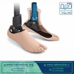 مزایای استفاده از کربن در پروتز و پنجه های کربنی