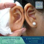 استفاده از پروتز گوش چه مزایا و معایبی دارد